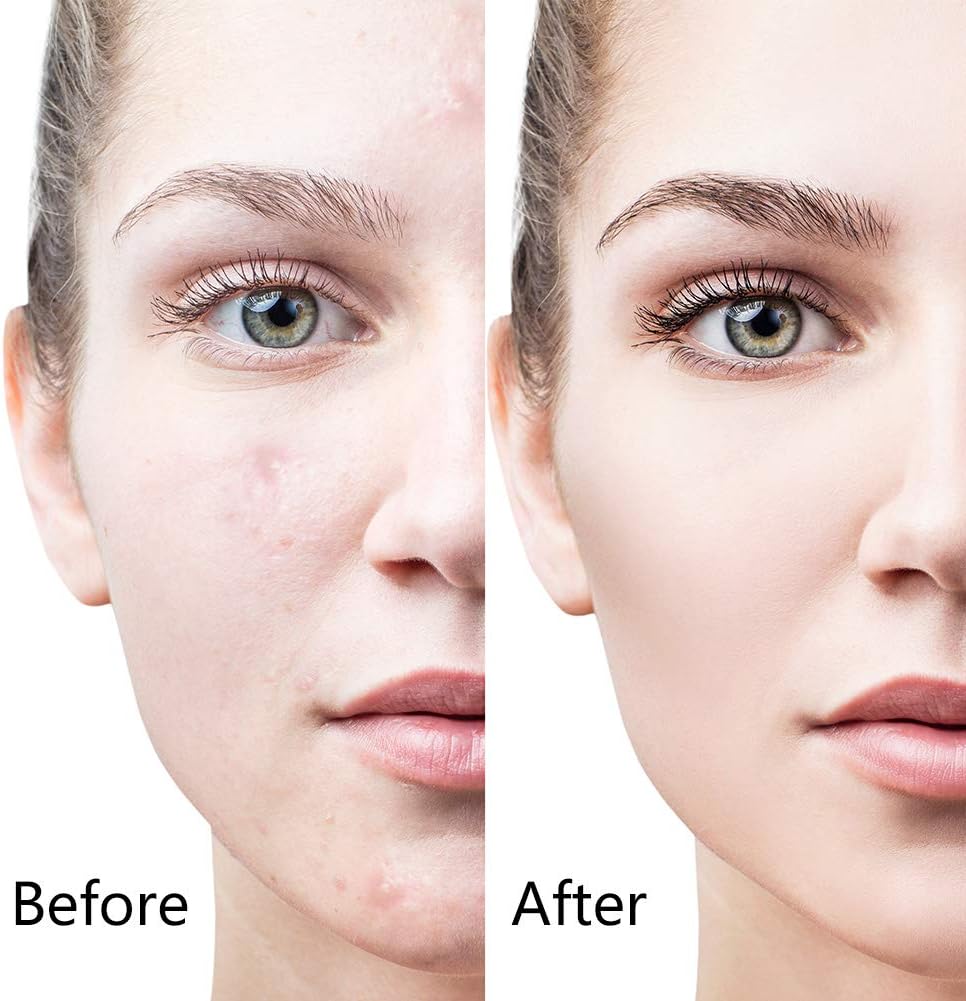 Derma Roller System